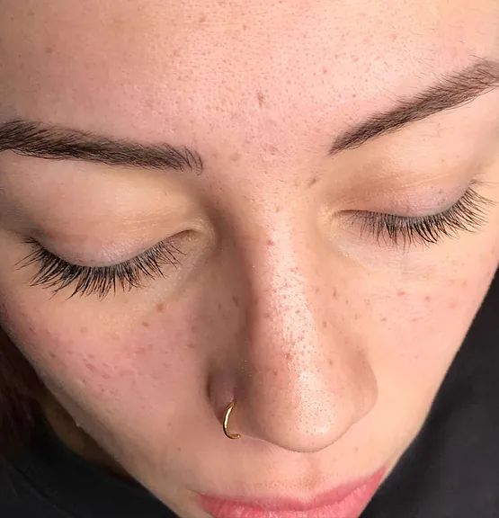 Micropigmentación de pecas (freckles)